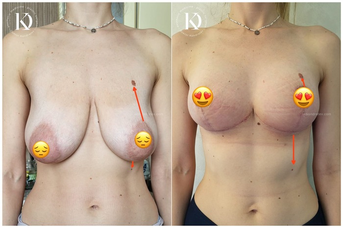 Are these breasts really without implants? - NSFW, My, The medicine, Doctors, Video, Vertical video, Longpost