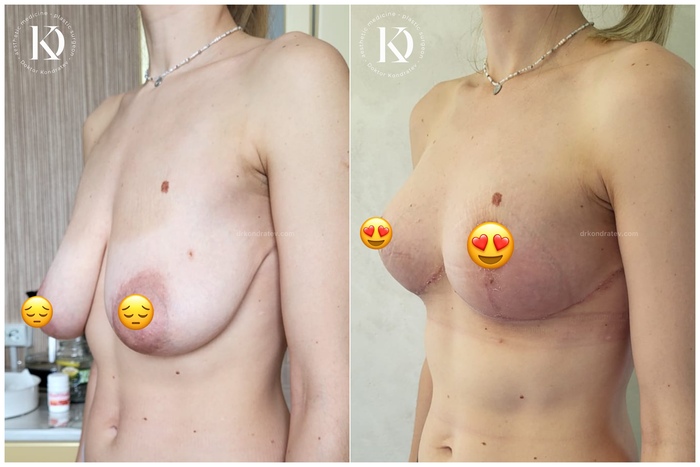 Are these breasts really without implants? - NSFW, My, The medicine, Doctors, Video, Vertical video, Longpost