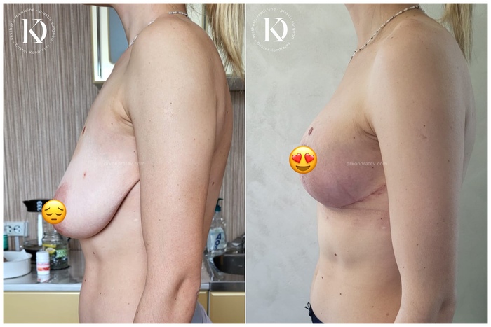 Are these breasts really without implants? - NSFW, My, The medicine, Doctors, Video, Vertical video, Longpost