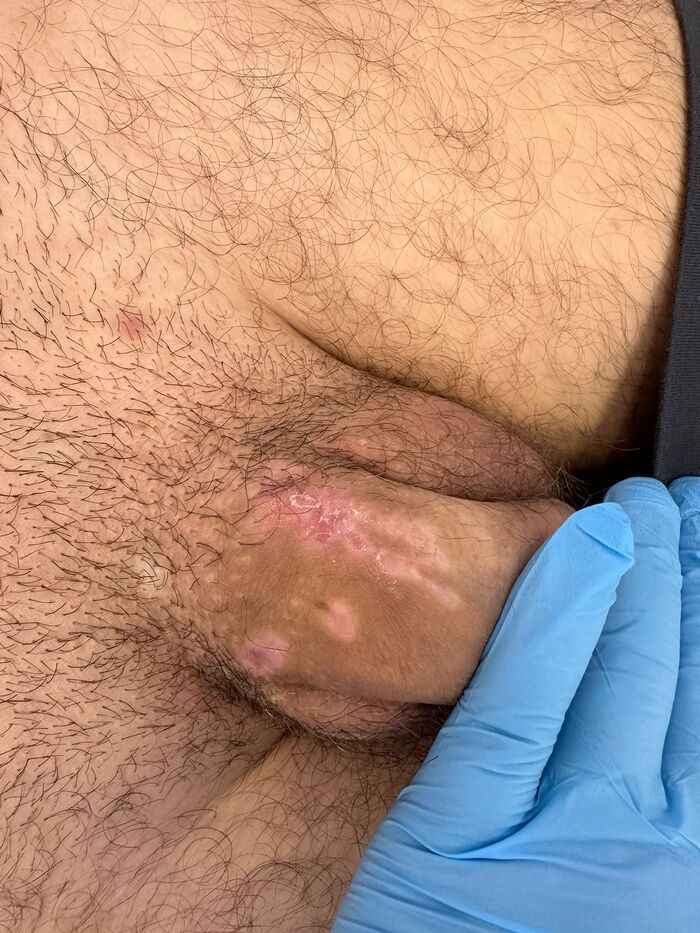 The power of the beaver. Finale - NSFW, My, Disease, Doctors, Operation, Hospital, Disease history, Urologist, Urology, Andrologist, Genital warts