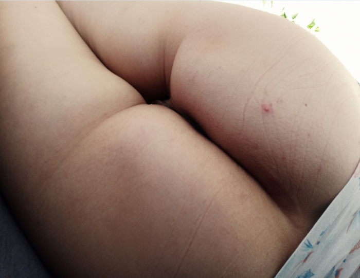 Seems - NSFW, My, Reply to post, Booty, Acne, Morning