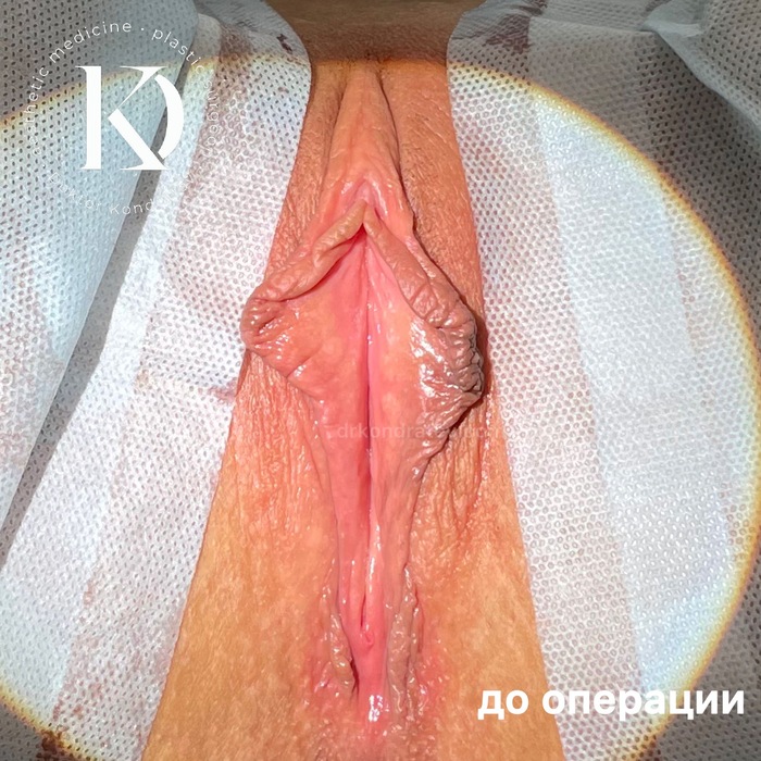 Интимная пластика - NSFW, Моё, Медицина, Врачи, Видео, Вертикальное видео, Половые губы